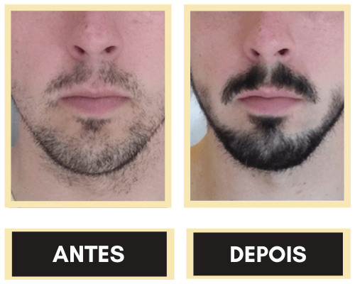 resultados antes e depois barba