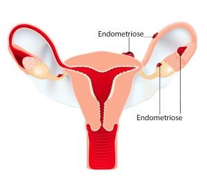 endometriose