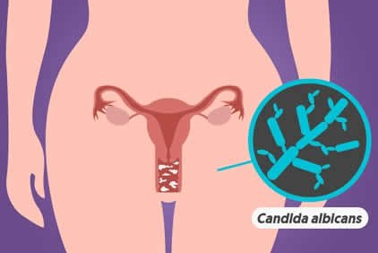 candidiase vaginal