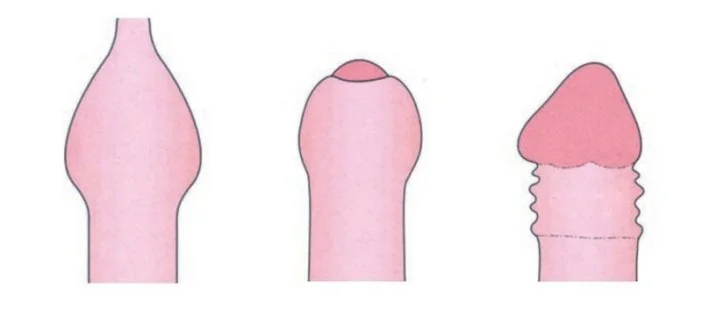 Como saber se tenho Fimose, tipos e principais tratamentos para fimose 1 como saber se tenho fimose