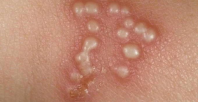 Bolinhas no pênis: Possíveis causas para esse bolinhas na cabeça do pênis 3 herpes no penis