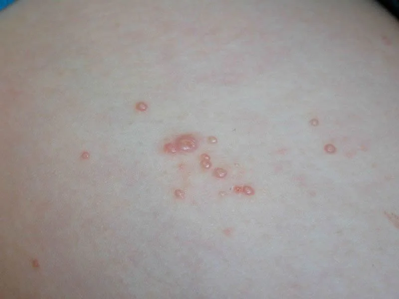 Bolinhas no pênis: Possíveis causas para esse bolinhas na cabeça do pênis 5 molusco contagioso na cabeça do pênis