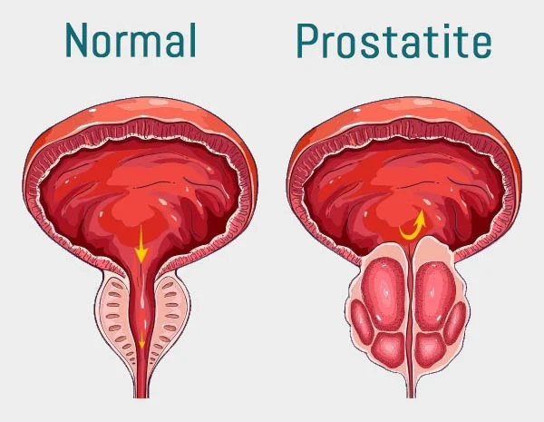 Prostatite: Causas, Sintomas e como tratar 3 Prostatite: Causas, Sintomas e como tratar