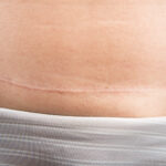 Tipos de Cicatrização da Pele: Como melhorar a cicatrização mais rápido