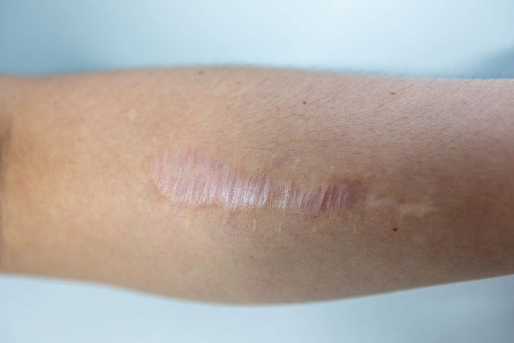 Tipos de Cicatrização da Pele: Como melhorar a cicatrização mais rápido 1
