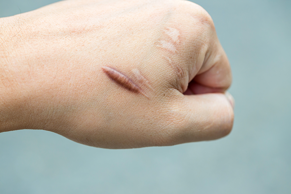 Tipos de Cicatrização da Pele: Como melhorar a cicatrização mais rápido 2