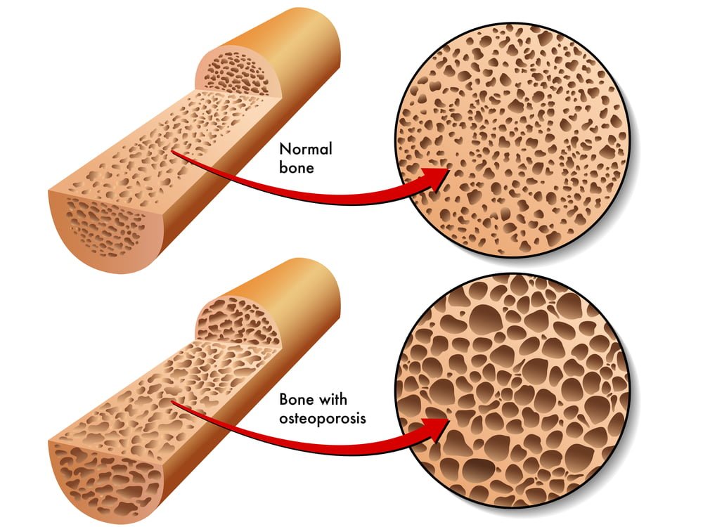 O que é Osteoporose? Como evitar e o que tomar para combater 4 osso com osteoporose