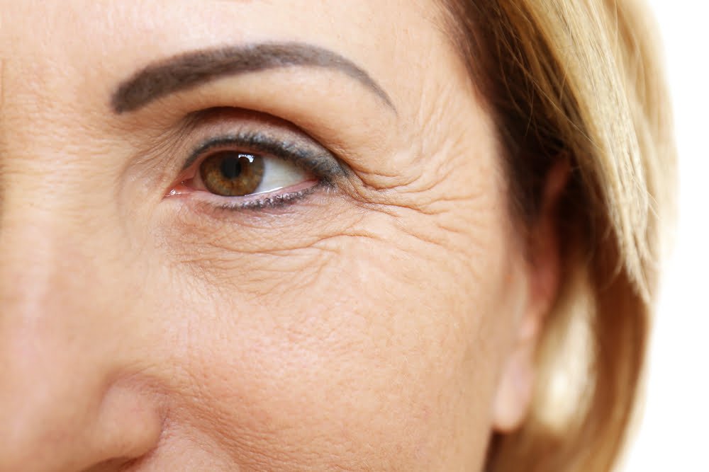 Rugas nos olhos: Como eliminar ou evitar 3 rugas nos olhos