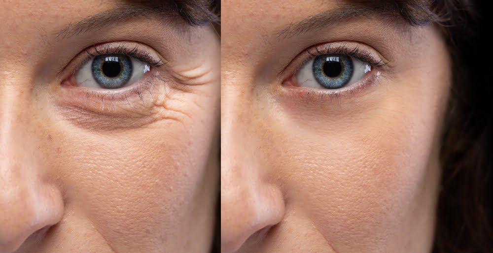 Rugas nos olhos: Como eliminar ou evitar 4 Rugas nos olhos: Como eliminar ou evitar 3