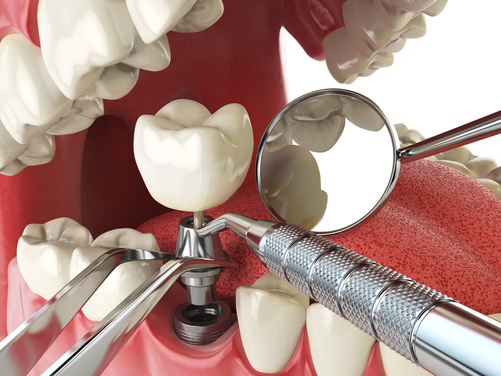 Implante dentário: o que é, quando é indicado e como é feito 4